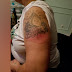 Moderna Arm : Covid Arm Skin Reactions At Injection Site Of Moderna Vaccine In Bc Case Reports British Columbia Medical Journal : It has a name now:
