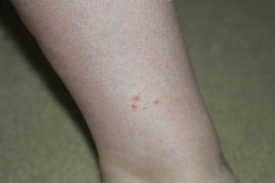 ... Bed Bug Bites On Ankle Pictures Of Bed Bug Bites On A Woman S Ankle By