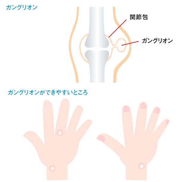 Q 手に目立つしこりのようなものがあります 手術が必要ですか 立川 今井皮フ形成外科クリニック