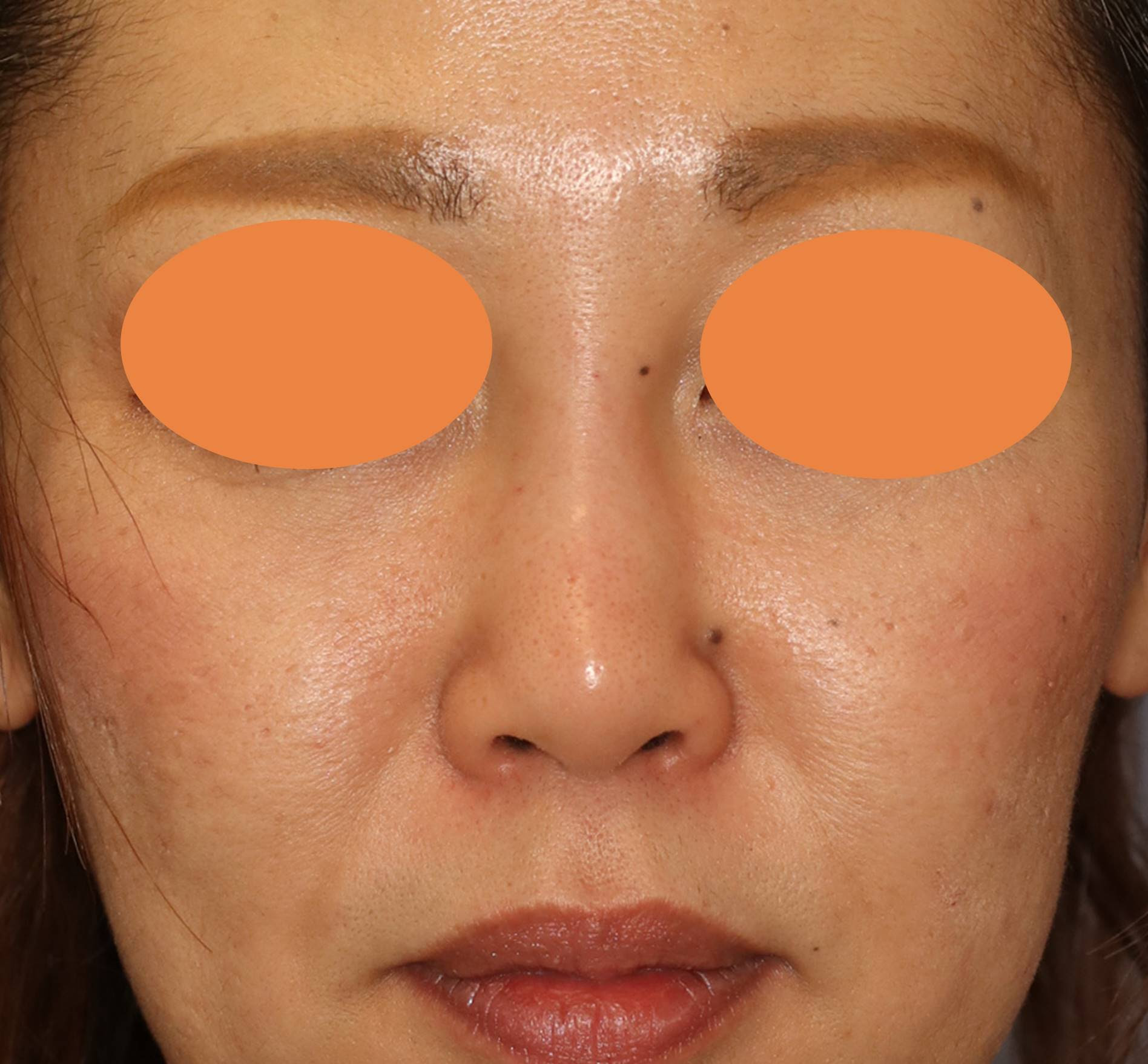 ヒアルロニダーゼの効果 鼻形成術前のヒアルロン酸除去 宮益坂クリニック