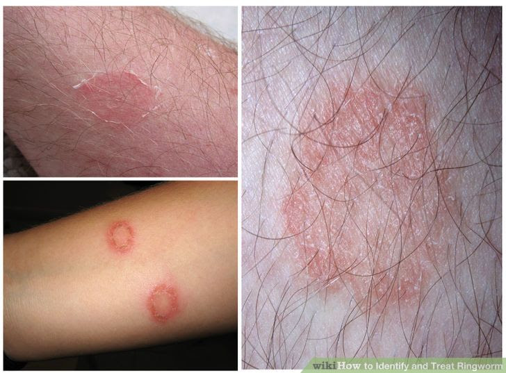 Ringworm 1.jpg