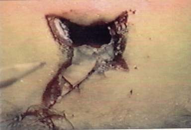 Resultado de imagen para Orificio de entrada de disparos a larga distancia