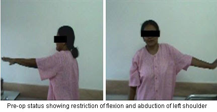 Frozen Shoulder Jointsurgery In