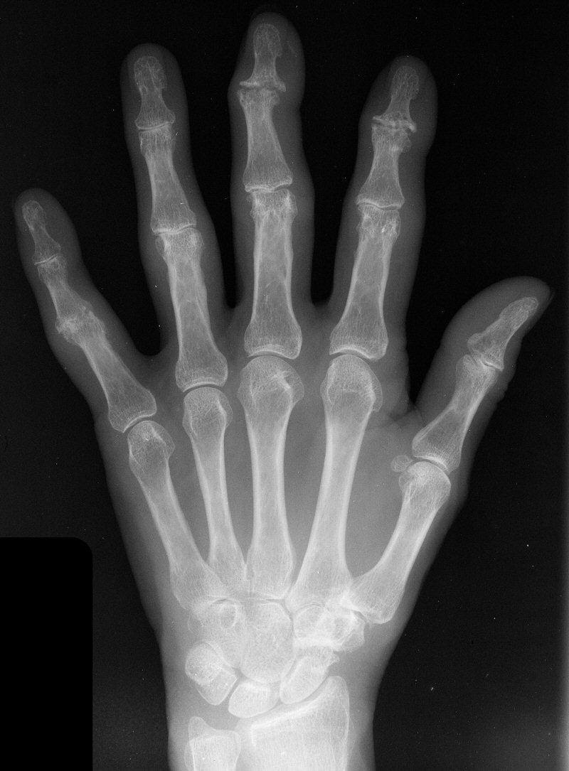 home remedy for arthritis in thumb joint