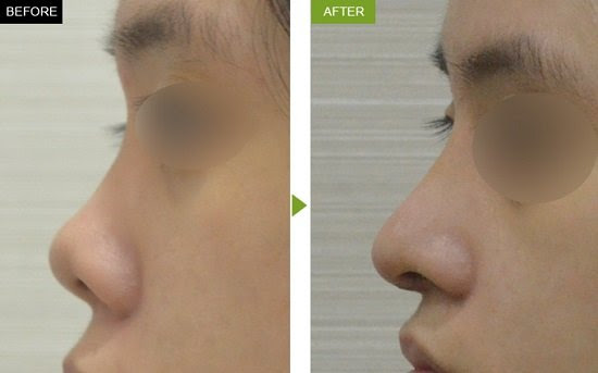 Chỉnh sửa mũi hếch thay đổi quan niệm tướng số