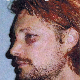 Gabriel Aubry Black Eye Pic
