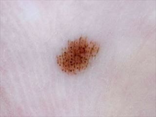 皮膚の悪性腫瘍 皮膚がん 品川区 あおよこ皮膚科クリニック