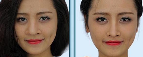 Phẫu thuật thu nhỏ cánh mũi giá bao nhiêu tiền