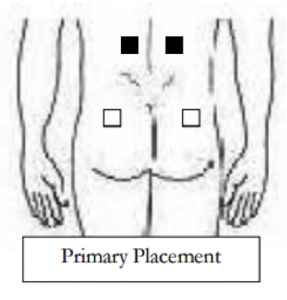 Complete Guide to your TENS Machine Pad Placements | TENS ...
