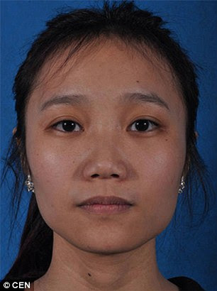 Yang Jiayi, a 21-year-old clerk, before surgery