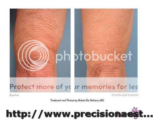 thermage before after. thermage0013-1.jpg thermage before after