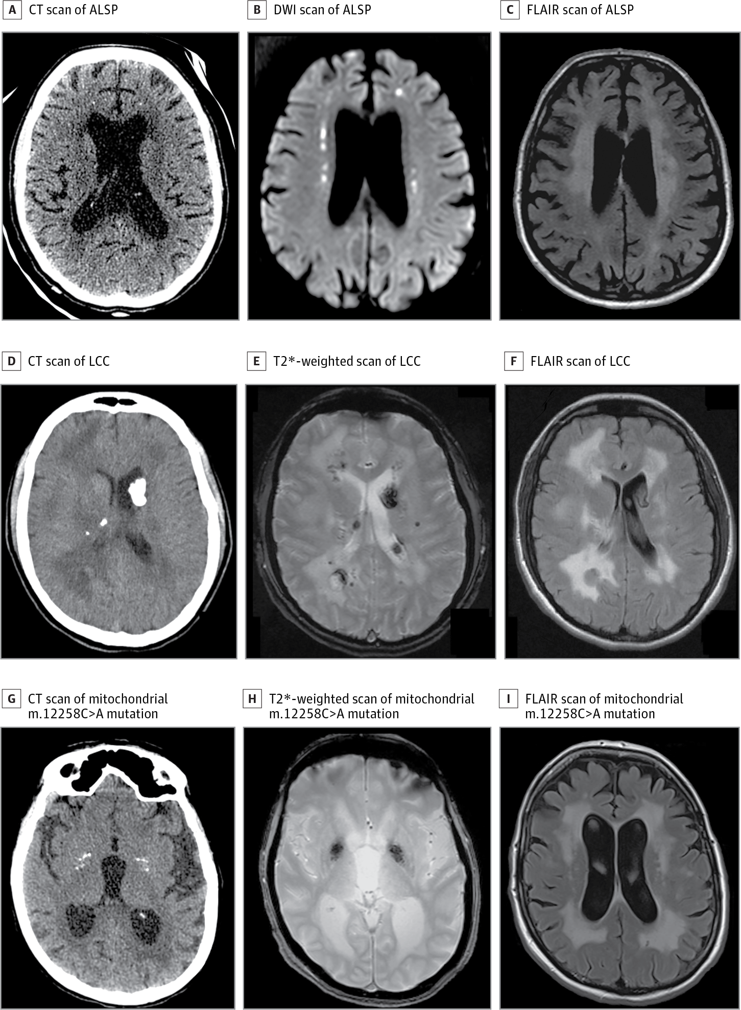 Vascular calcifications