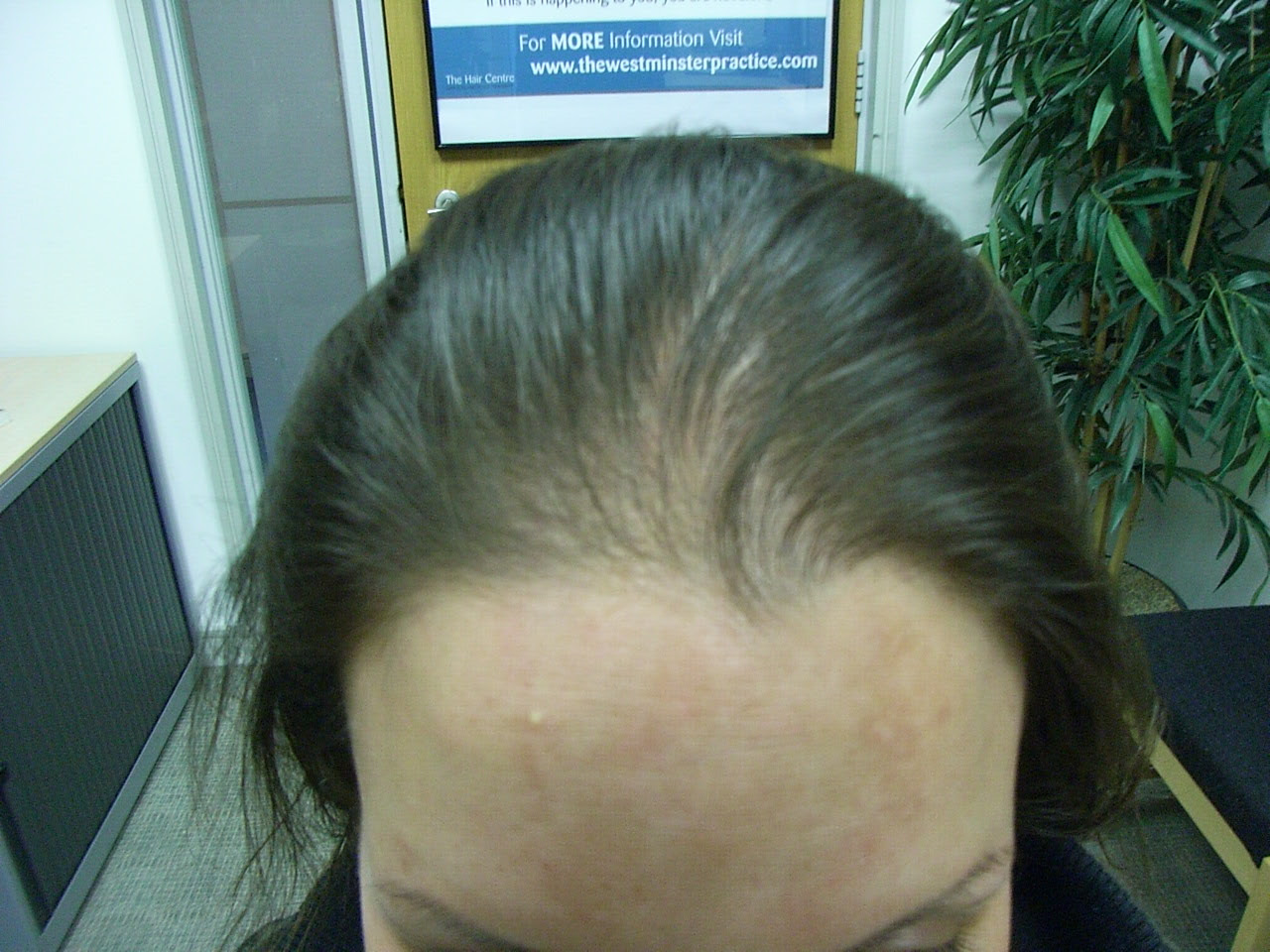 hair loss female