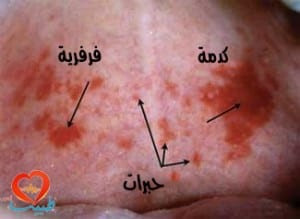 طبيب ع جلدية كدمات