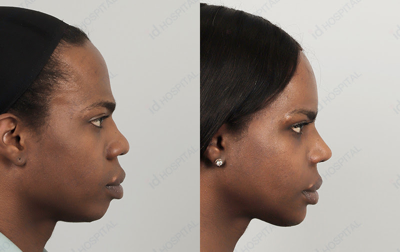 upper facial feminization surgery