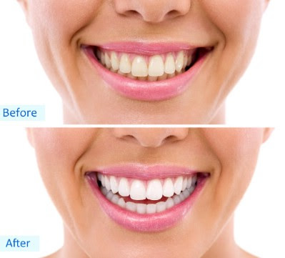 Whiten your teeth - 51 Extraordinary Everyday Uses for Hydrogen Peroxide