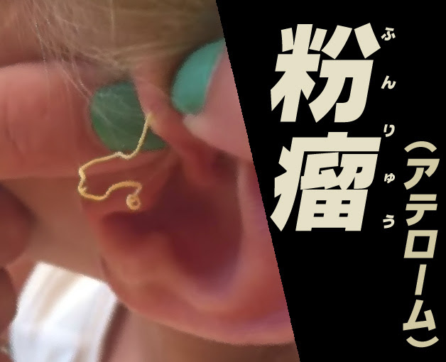お腹や背中 首 耳から脂肪みたいなのがニュルニュル出てくる それは粉瘤 アテローム ワールド ワイド ウェブログ