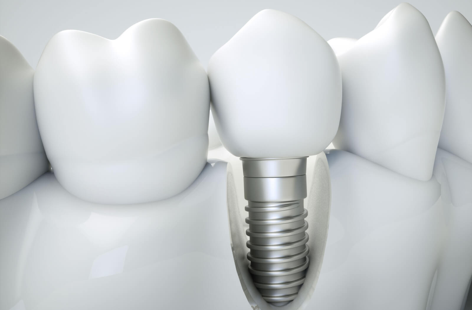 A model of a jaw, showing a tooth with an implant screw going down into the jaw.