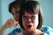 Suspected Agent Orange victim Nguyen Thi Hong Van, 11, and her mother Nguyen Thi Luu, 38 are pictured at their home near Danang city's airport on August 8, 2012.