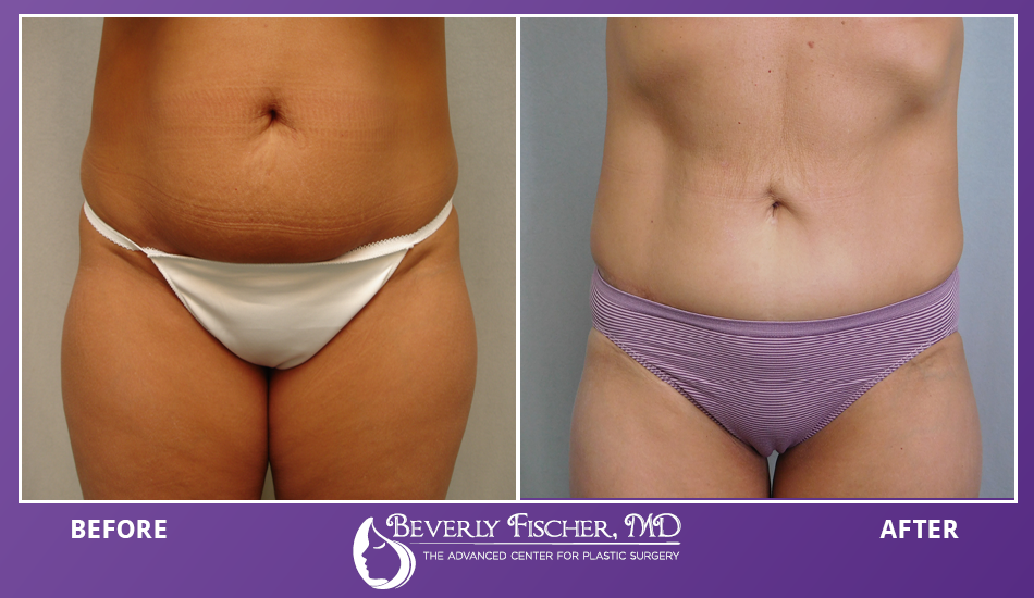 liposuction before and after