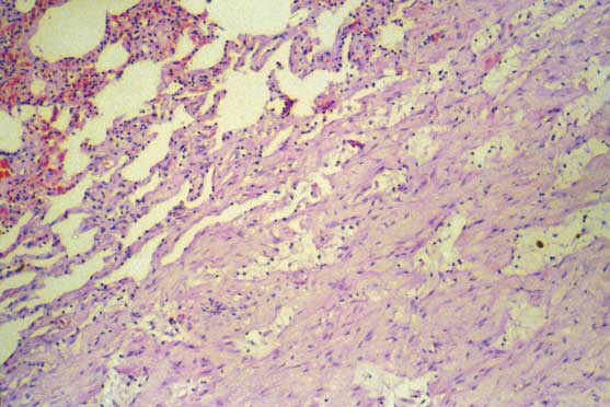 Mature interstitial fibrosis.