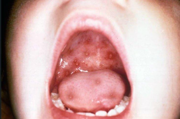 Fotos da doença mão-pé-boca | MD.Saúde