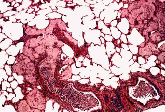 Chronic peribronchiolitis with mucopurulent exudates in airways extending into adjacent alveoli.