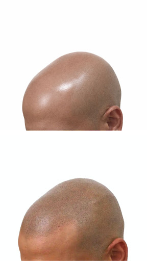 shaved look smp antwerpen,buzz cut haar tattoo antwerpen,scalp micropigmentation kaal antwerpen,kaalheid oplossing man antwerpen,geschoren look micropigmentatie antwerpen,smp kale man belgie,haar tattoo buzz cut antwerpen,alternatief haartransplantatie antwerpen,dr pixel antwerpen shaved look,lotta medical scalp micropigmentation