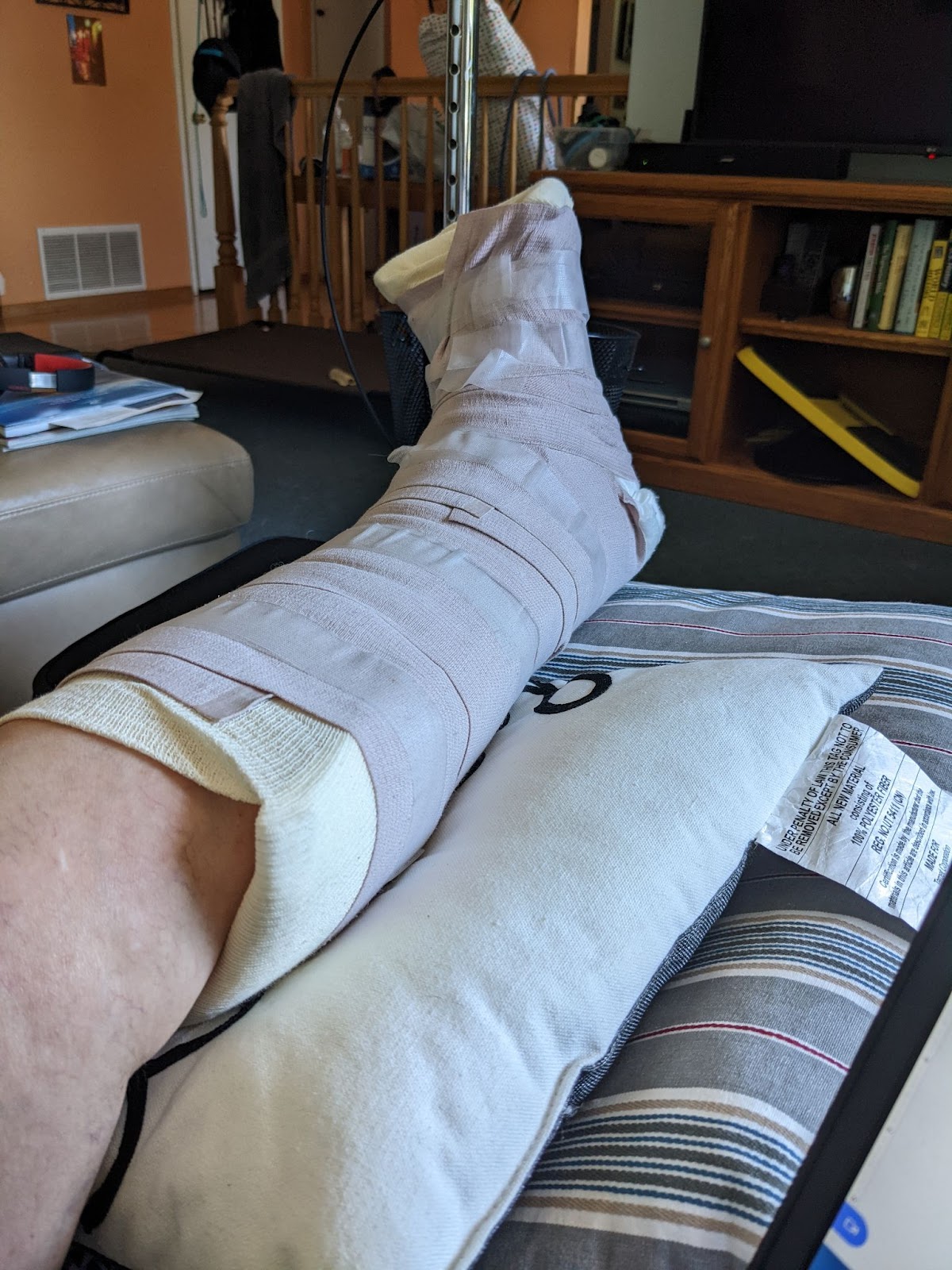 Left leg wrapped in surgical dressing and splints, propped up on pillows