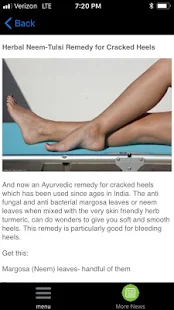 Cracked Heels Remedy(圖5)-速報App