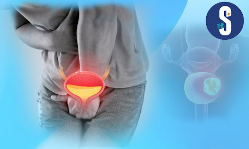 Develops when cells in the bladder begin to grow abnormally, forming a tumor in the ...