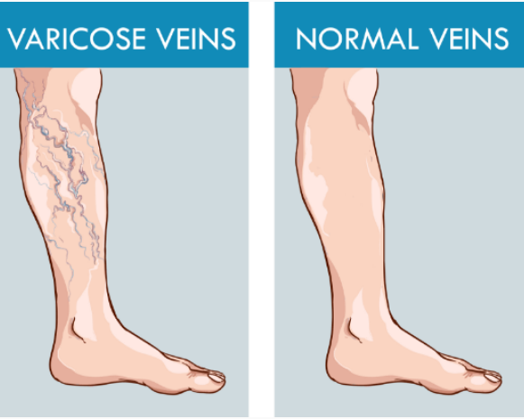 Legs with normal veins and varicose veins