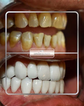 veneers Lebanon LB Lumineers exclusive provider Ferrari Dental Jounieh Smile Infinity 2026