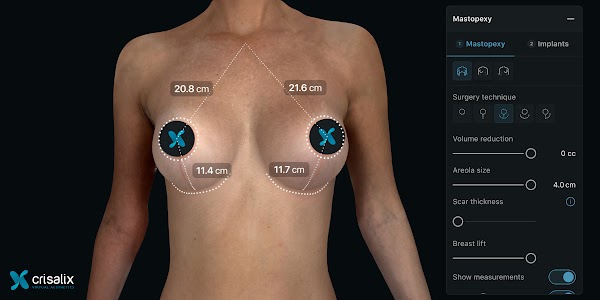 Simulation mammaire 3D dans l’application Crisalix avec l’outil de procédure « Mastopexy » ouvert. 2400px x 1200px.