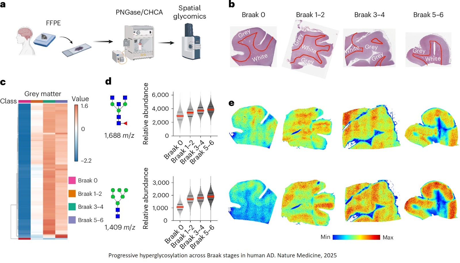 Hyperglycosylation is a metabolic driver of Alzheimer’s disease
