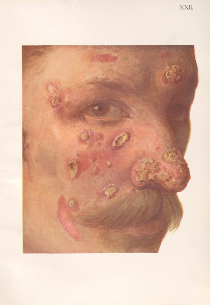 Venereal diseases  Syphilis Pl22 1908