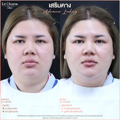 เสริมคาง