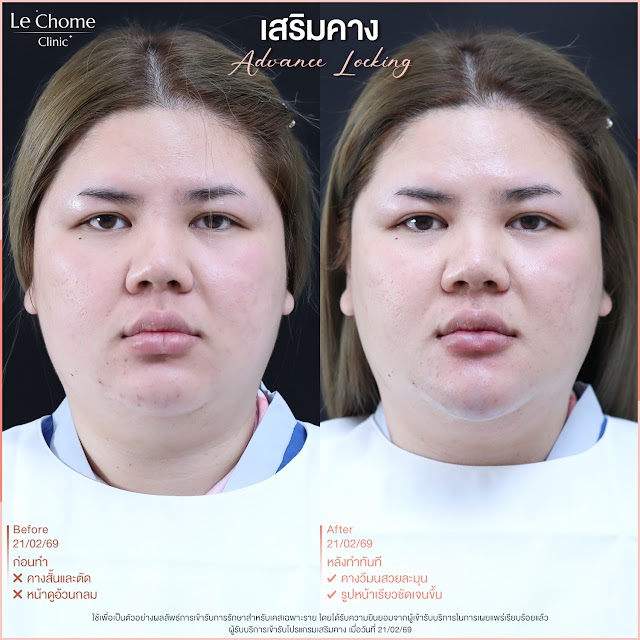 รีวิวเสริมคาง — เสริมคาง