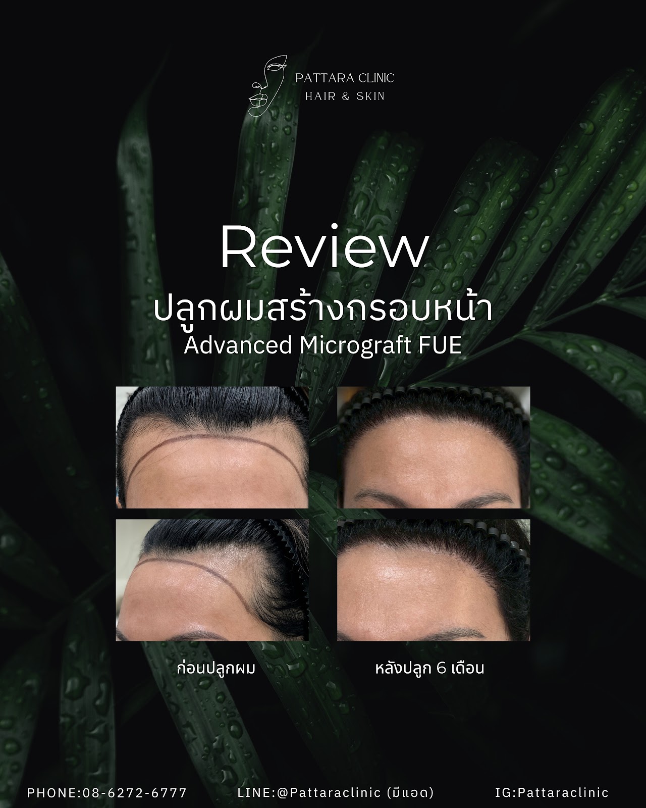 รีวิวปลูกผมถาวร Advanced Micrograft FUE