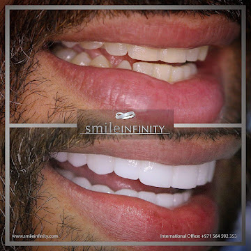 Hollywood smile medical tourism Lebanon Ferrari Dental Clinic Smile Infinity 2026