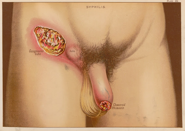 Syphilis  A case of chancroid phimosis accompanied with gangrenous bubo 1889