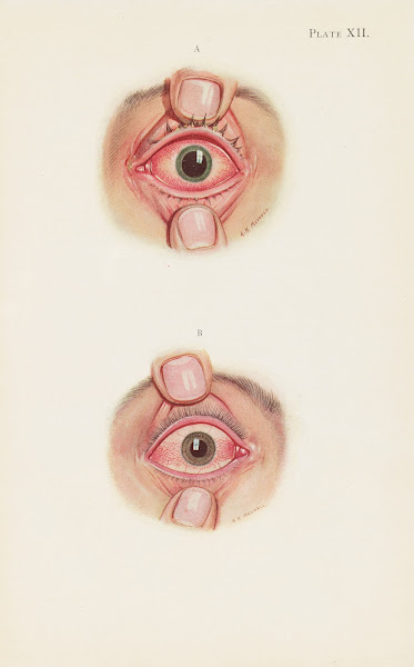 Plate XII A Stage of resolution after severe burning B Late stage of resolution