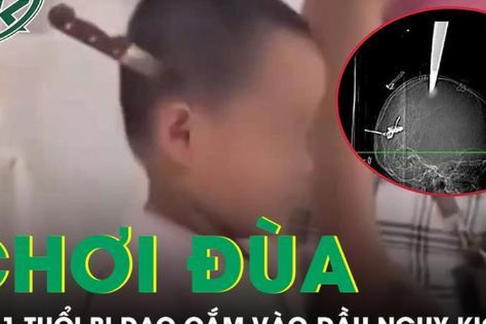 Hai anh em chơi đùa tại nhà, bé 11 tuổi bị dao cắm vào đầu nguy kịch - Báo Sức Khỏe &amp; Đời Sống