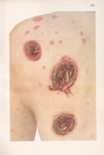 Venereal diseases  Syphilis Pl12 1908
