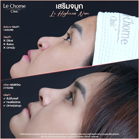 เสริมจมูก