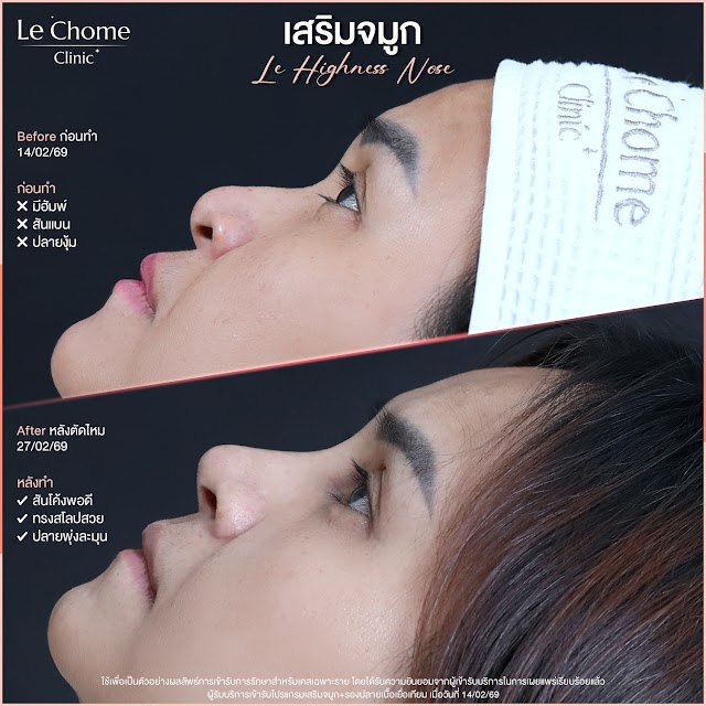 รีวิวเสริมจมูก — เสริมจมูก