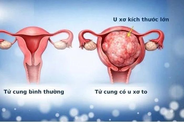 Chưa chồng, u xơ tử cung lớn đã lan từ tiểu khung lên ổ bụng - Báo Tri thức &amp; Cuộc sống