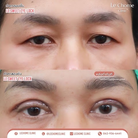 ตา 2 ชั้น