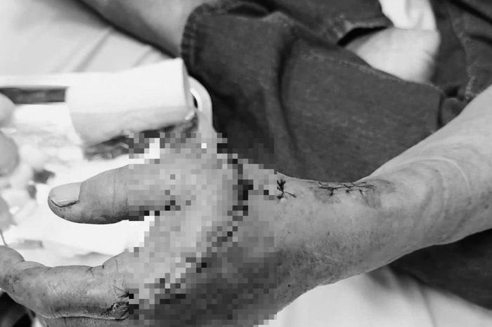 Sử dụng cưa máy, người đàn ông bị lưỡi cưa cắt gãy xương, đứt gân - Báo Tri thức &amp; Cuộc sống