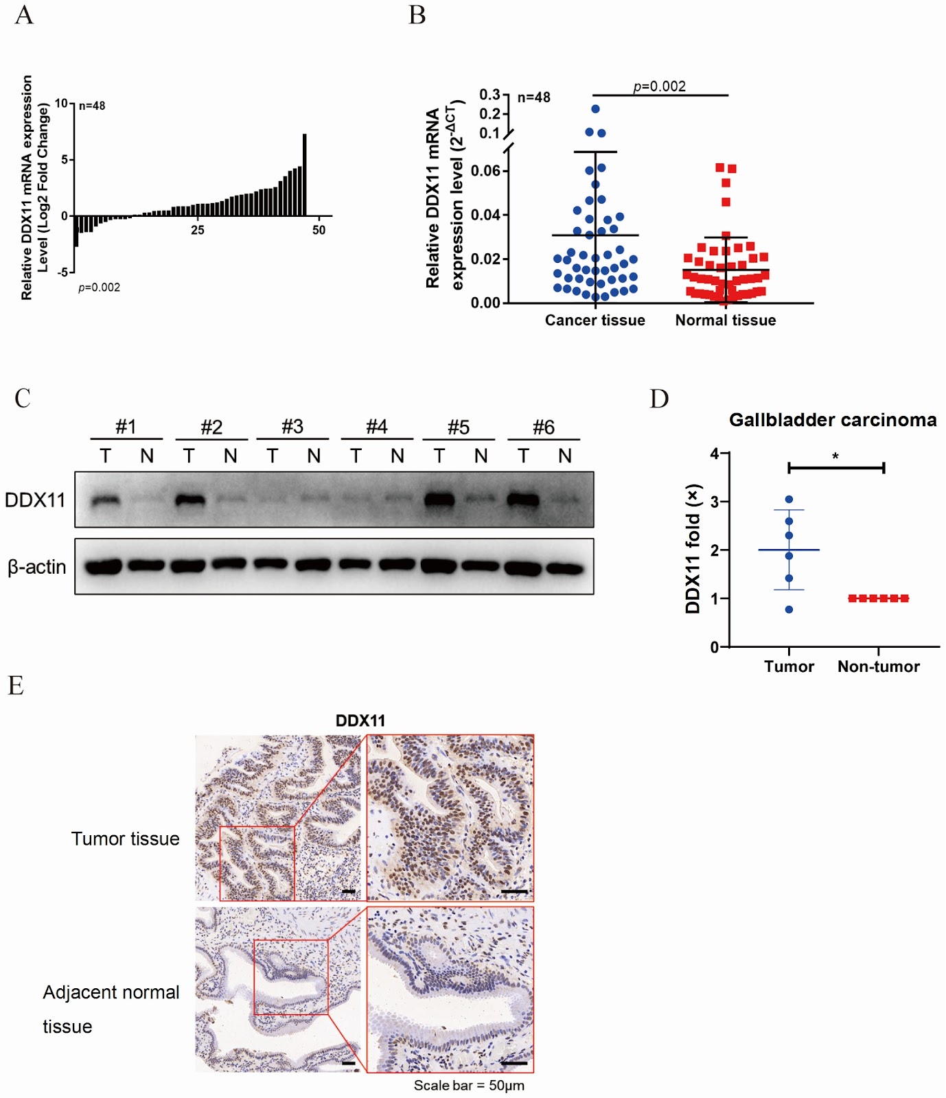 DDX11 interacts with PARP1 to facilitate PARylation, thereby promoting gallbladder cancer progression and conferring gemcitabine resistance